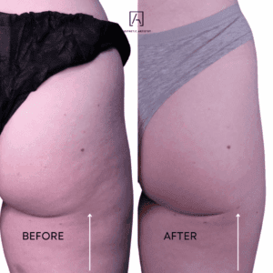 alloClae before and after result 1