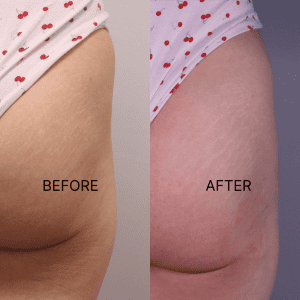 alloClae before and after result 5