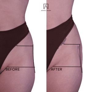 alloClae before and after result 3