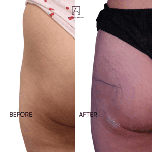 alloClae before and after result 4