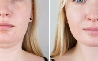 Choosing the Right Double Chin Treatment