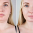 Choosing the Right Double Chin Treatment
