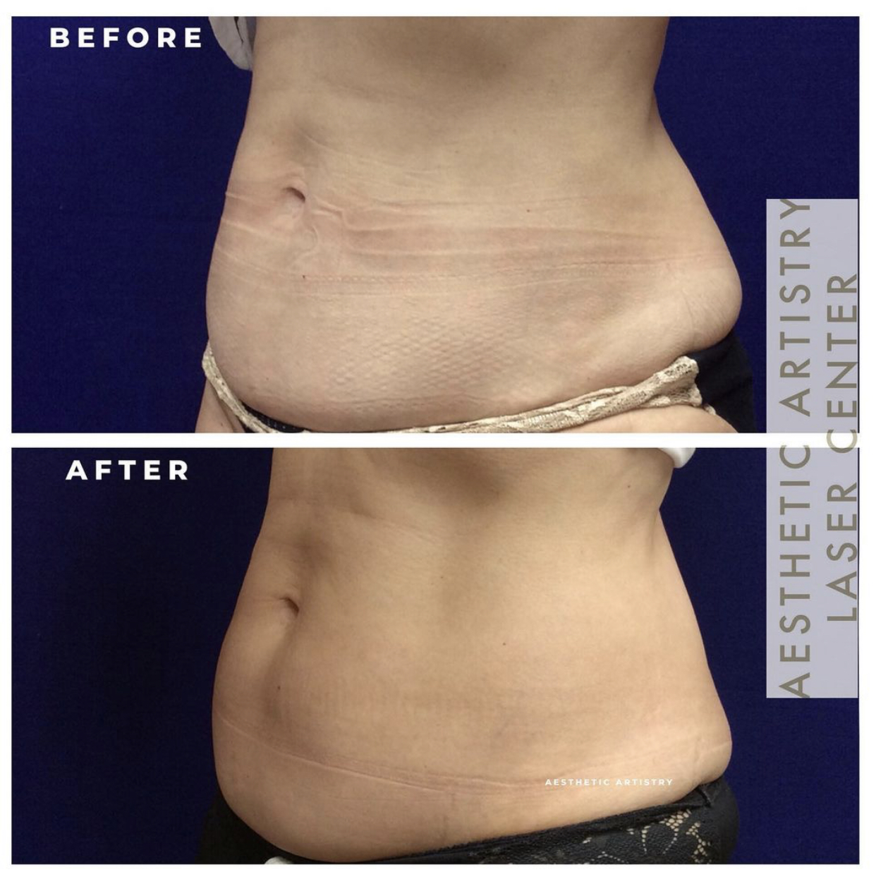 CoolSculpting Fat Removal - Style Aesthetics by RajaniMD